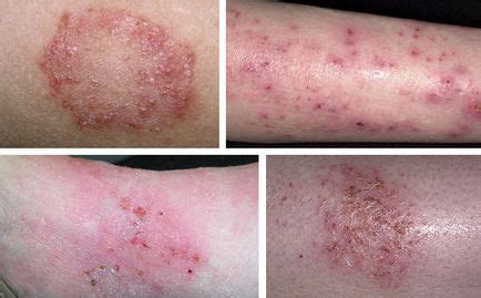 eczema varicoasă pe picioare tratament cu remedii populare